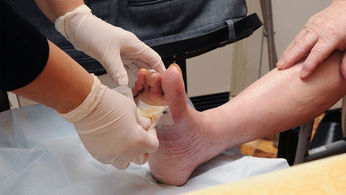 AAN Updates Painful Diabetic Neuropathy Guidance